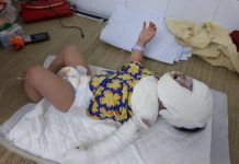 Nghẹn lòng trước khuôn mặt bé 9 tháng tuổi biến dạng vì ngã vào bếp lửa