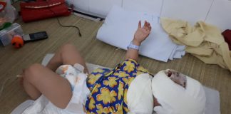 Nghẹn lòng trước khuôn mặt bé 9 tháng tuổi biến dạng vì ngã vào bếp lửa