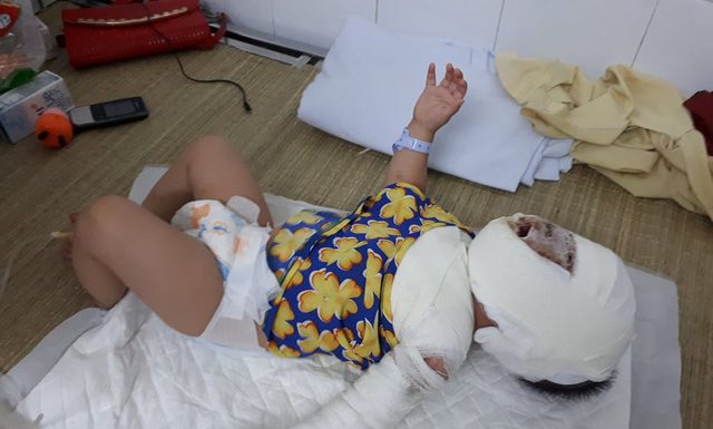 Nghẹn lòng trước khuôn mặt bé 9 tháng tuổi biến dạng vì ngã vào bếp lửa